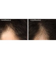HairMax - profesionalni laserski glavnik 12